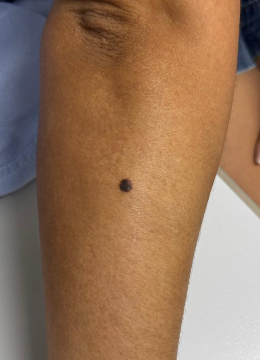 Melanoma no antebraço — pinta escura com bordas irregulares